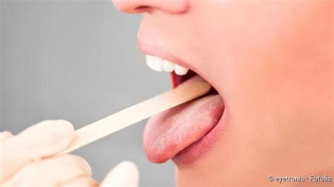 Tonsil Stones Causes Signs Removal Ims