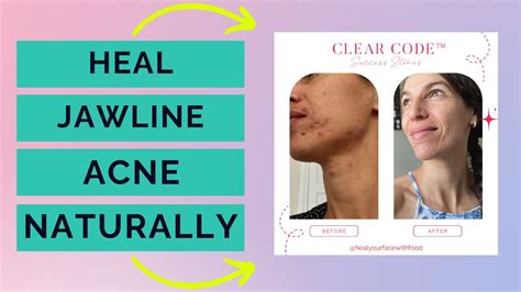 How To Get Rid Of Jawline Acne Naturally Youtube