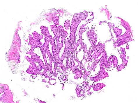 Pathology Outlines Solitary Rectal Ulcer Syndrome