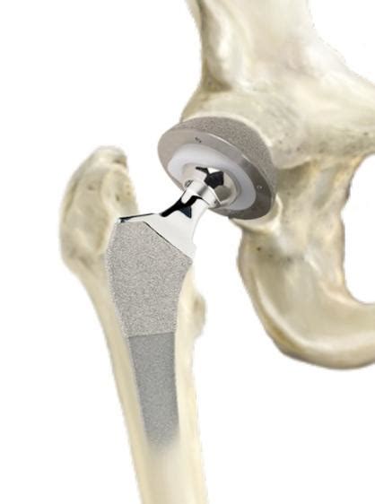 Superpath Hip Replacement
