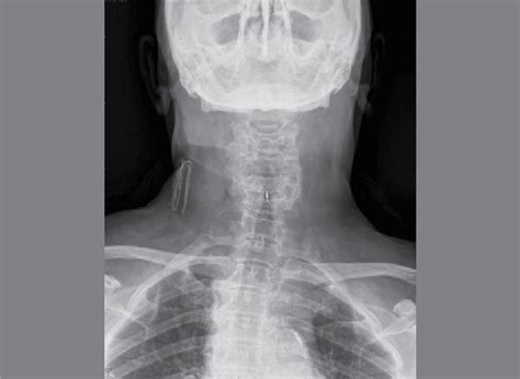 Postoperative Cervical Spine Ap X Ray Download Scientific Diagram