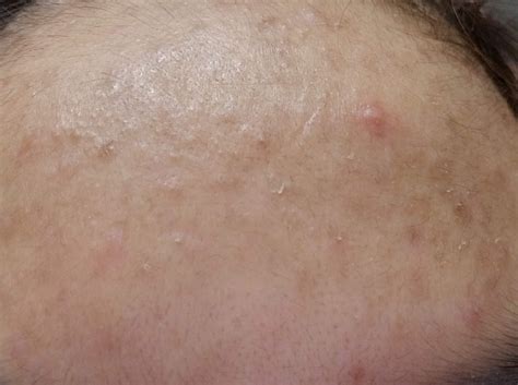 Acne Help With Sebum Plugsfilaments On Forehead And Nose R