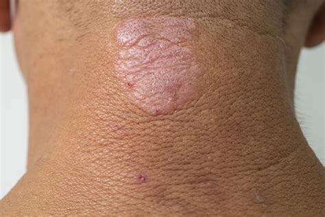 Treating Eczema Dermcare Scannon Dermatology