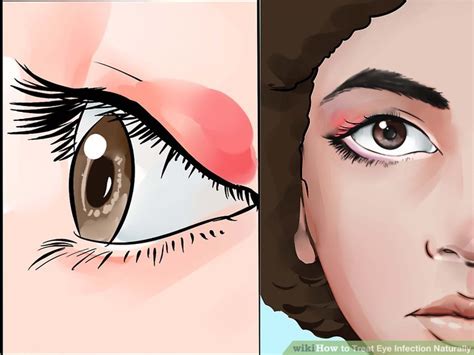 6 Ways To Treat Eye Infection Naturally Wikihow