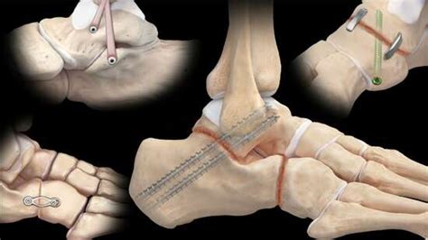 Flatfoot Deformity General Surgical Considerations With Stages Iii And