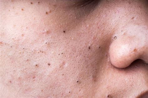 Does Accutane Get Rid Of Blackheads Best Guide For 2021