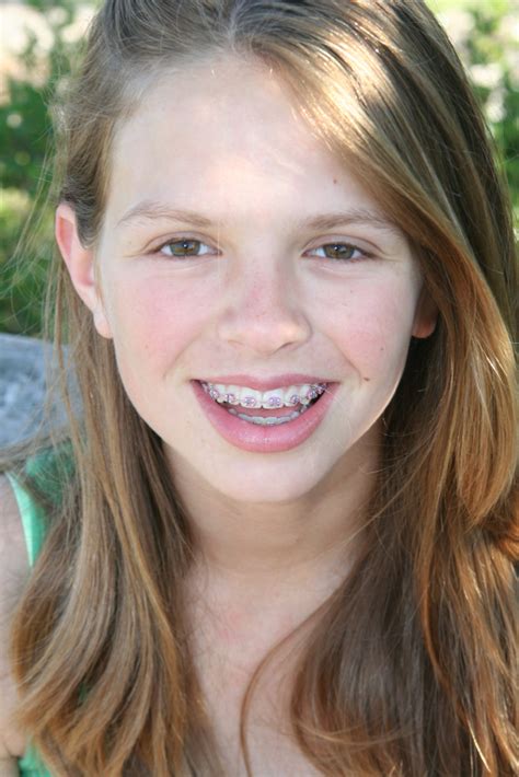 Children And Adult Braces Andover And North Andover Ma Merrimack
