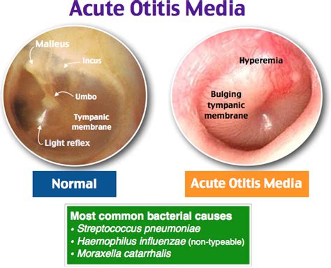 Acute Otitis Media Coggle Diagram Gambaran