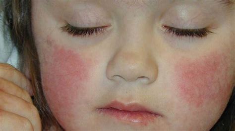 Rash And Swollen Lymph Nodes Causes Pictures And Treatment Healthy