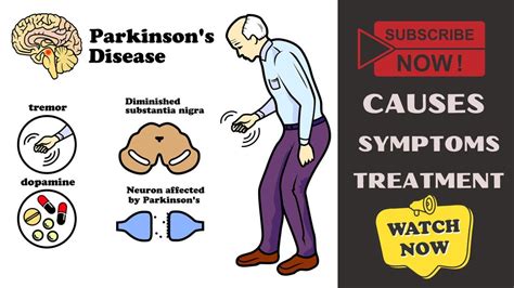 Parkinson Disease Causes Symptoms Treatment Symptoms Of Parkinson