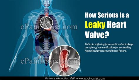 How Serious Is A Leaky Heart Valve
