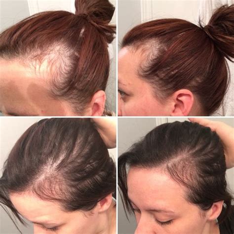 Hair Loss Months Postpartum What You Need To Know All About Best