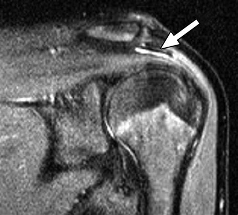 Rotator Cuff Impingement Correlation Between Findings On Mri And