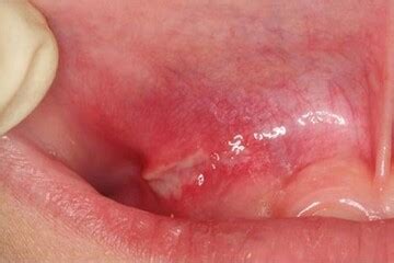 Canker Sores Aphthous Ulcer Causes Symptoms Diagnosis Stockton Dental Clinic