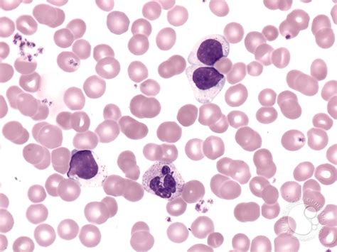 Large Granular Lymphocyte Leukemia 1