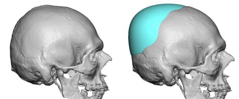 Male Custom Skull Implant Fro Flat Back Of The Head Design Dr Barry