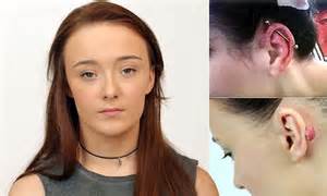Student Left With Keloid Scar After Ear Piercing As An Act Of Teenage