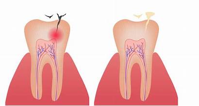 Dental Fillings Filling Tooth Colored Teeth Metal