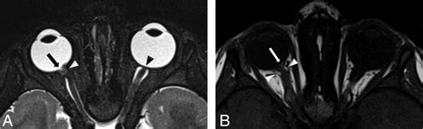 Morning Glory Disc Anomaly Characteristic Mr Imaging Findings American Journal Of Neuroradiology