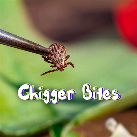 Dealing With Chigger Bites Prevention And Treatment Babieblue