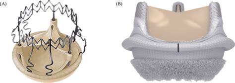 Sutureless And Rapid Deployment Valves A Perceval Sutureless Aortic Download Scientific