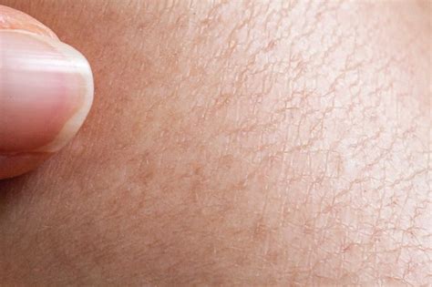 Natural Remedies For Extremely Dry Skin Livestrongcom