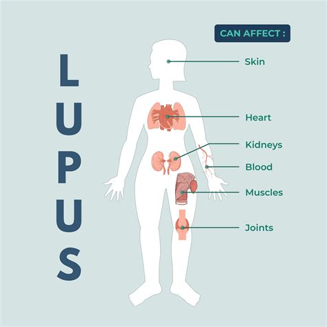 Is Lupus Hereditary An Overview Of Genetic Factors Xcode Life