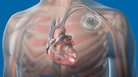 Implantable Defibrillator Pacemakers Do Not Help Diabetics Thailand