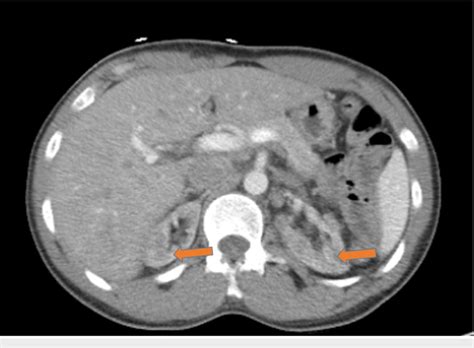 Ct Of The Abdomen And Pelvis Without Intravenous Contrast In An Axial