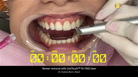 Veneer Removal With Litetouch™ Eryag Laser Youtube