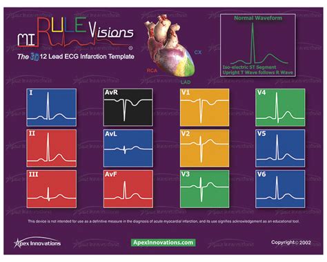 Both produce the same spectrum of ecg changes and symptoms and are managed identically in the emergency department. Apex Innovations :: Products :: MI Rule Visions(R) (ECG ...