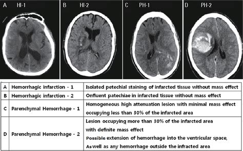 Figure 4 From Magnetic Resonance Imaging In Acute Ischemic Stroke