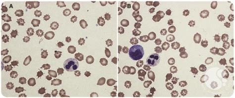 Acanthocytosis Causing Chronic Hemolysis In A Patient With Advanced