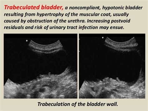 Presentation1pptx Ultrasound Examination Of The Urinary Bladder And