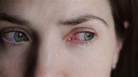 Allergic Conjunctivitis Causes Symptoms And Treatment Allergy
