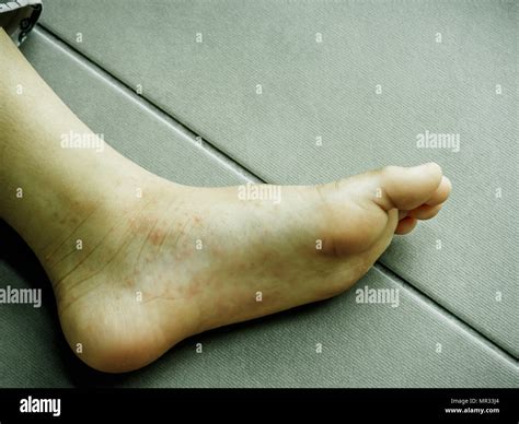 Hand Foot And Mouth Disease Closeup Allergic Rash Skin Of Kids Foot