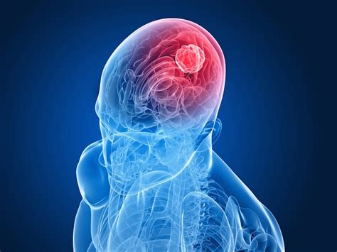 Advanced Cell Therapies For Glioblastoma Glio