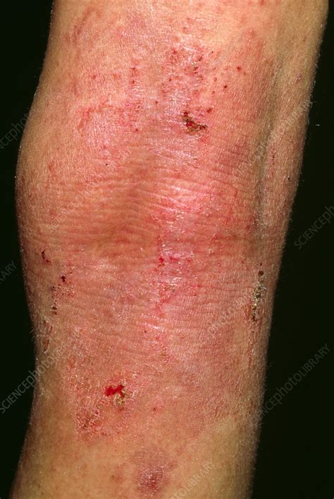 Acute Eczema Seen On The Leg Of 12 Year Old Boy Stock Image M150