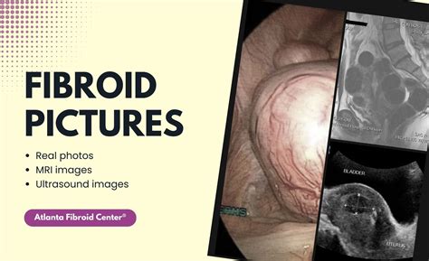 Real Pictures Of Fibroids Mri Ultrasound Images Pics