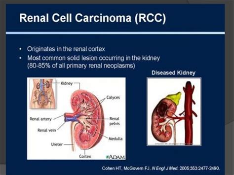 Renal Cell Carcinoma Radiology