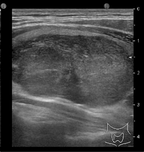 Thyroid Nodule Ultrasound