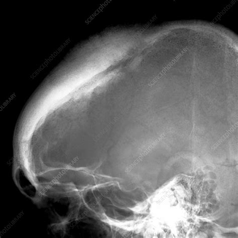 Brain Tumour X Ray Stock Image C0299956 Science Photo Library