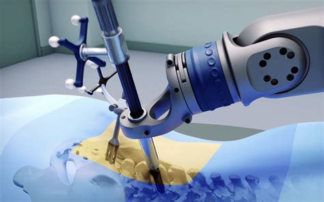 Robotic Lumbar Spine Surgery At Progressive Spine And Orthopaedics