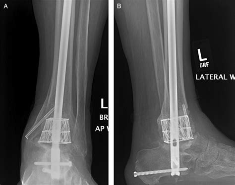 Salvage Of Failed Total Ankle Replacement Using A Custom Titanium Truss