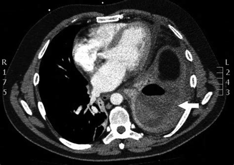 Ct Image Of A Lung Abscess With A Thick Enhancing Wall And An Air