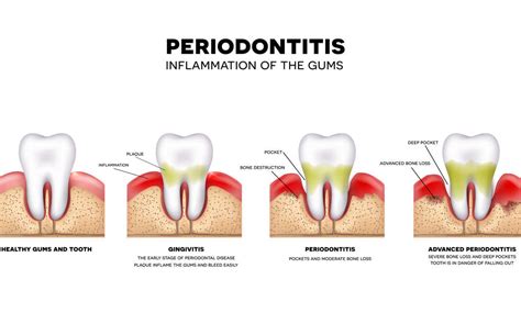 The Difference Between Gingivitis And Periodontitis Dental Arts San Diego