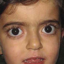 Exophthalmia (countable and uncountable, plural exophthalmias). (PDF) Graves Disease with Exophtalmia in a Two-Year Old Child