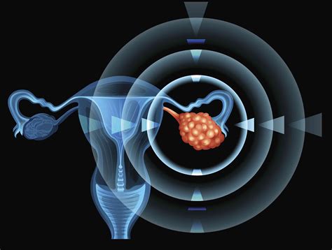 Partial hysterectomy or total hysterectomy. What Tests Evaluate an Ovarian Mass for Cancer?