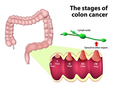 Colorectal Cancer Stages Colorectal Cancer Alliance