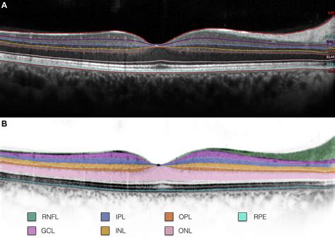 Normative Data For Retinal Layer Thickness Maps Generated By Spectral